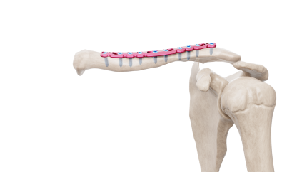 Pelvis Rekonstrüksüyon Düz Plak